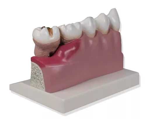 Erler-Zimmer Dentalmodell 4 fache Größe