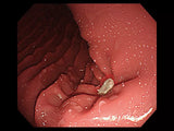 Erler-Zimmer OGD Oesophago Gastro Duodenoskopie Simulator