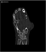 Erler-Zimmer Handphantom für CT, Röntgen und Strahlentherapie