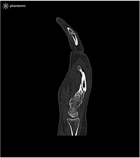 Erler-Zimmer Handphantom für CT, Röntgen und Strahlentherapie