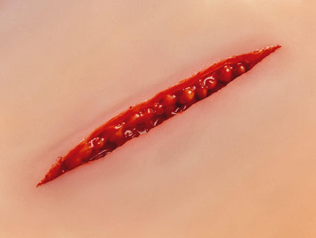 Erler-Zimmer Wundmoulage Schnittwunde