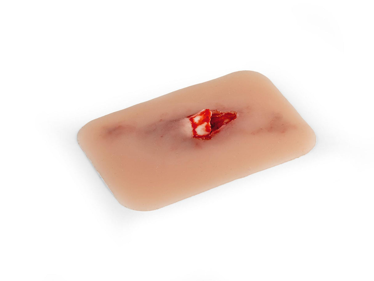 Erler-Zimmer Wundmoulage offener Knochenbruch