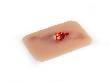 Erler-Zimmer Wundmoulage offener Knochenbruch