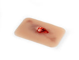 Erler-Zimmer Wundmoulage offener Knochenbruch