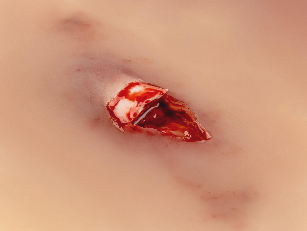 Erler-Zimmer Wundmoulage offener Knochenbruch