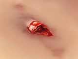 Erler-Zimmer Wundmoulage offener Knochenbruch
