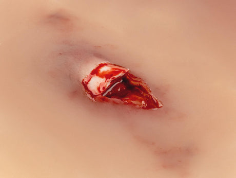Erler-Zimmer Wundmoulage offener Knochenbruch