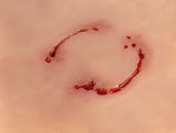 Erler-Zimmer Wundmoulage Bisswunde Mensch