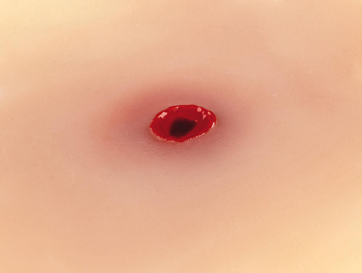 Erler-Zimmer Wundmoulage Einschußwunde