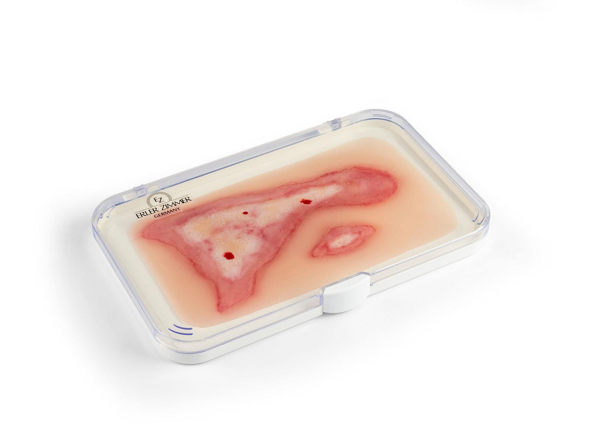 Erler-Zimmer Wundmoulage Verbrühung