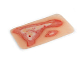 Erler-Zimmer Wundmoulage Verbrühung