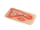 Erler-Zimmer Wundmoulage Verbrühung