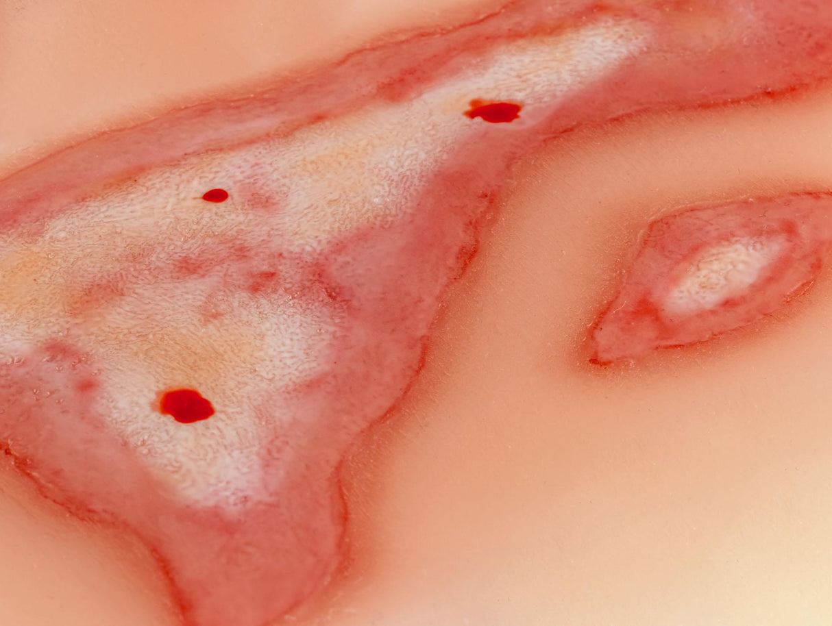 Erler-Zimmer Wundmoulage Verbrühung