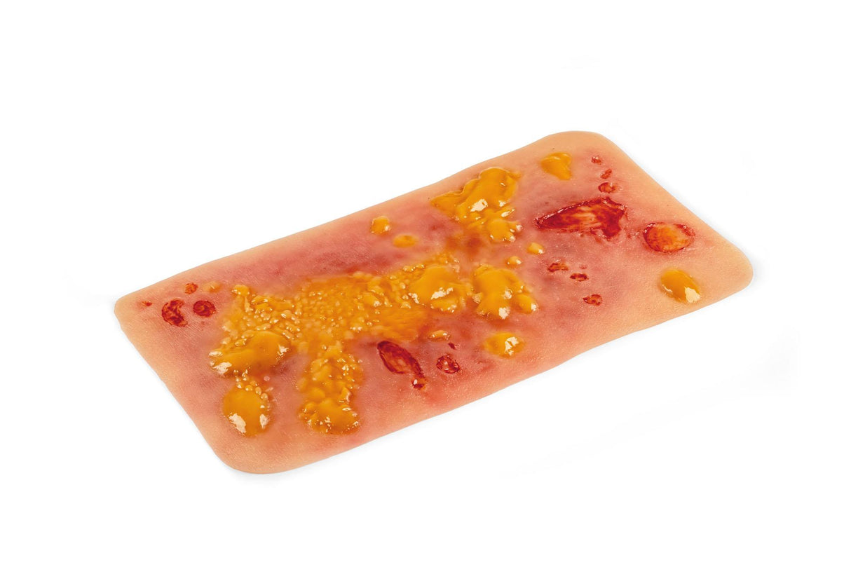 Erler-Zimmer Wundmoulage Verbrennung II. Grades
