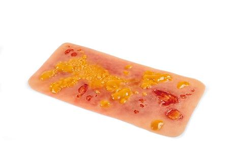 Erler-Zimmer Wundmoulage Verbrennung II. Grades