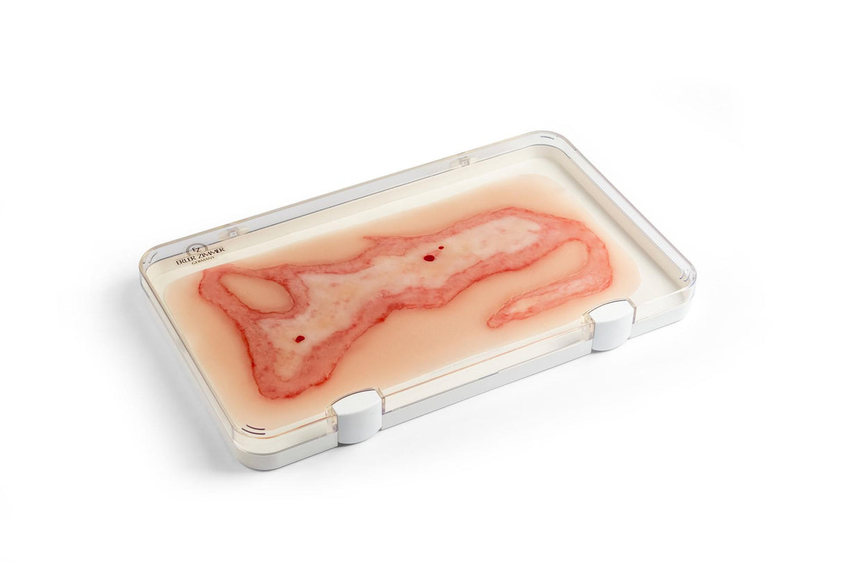Erler-Zimmer Wundmoulage Verbrühung