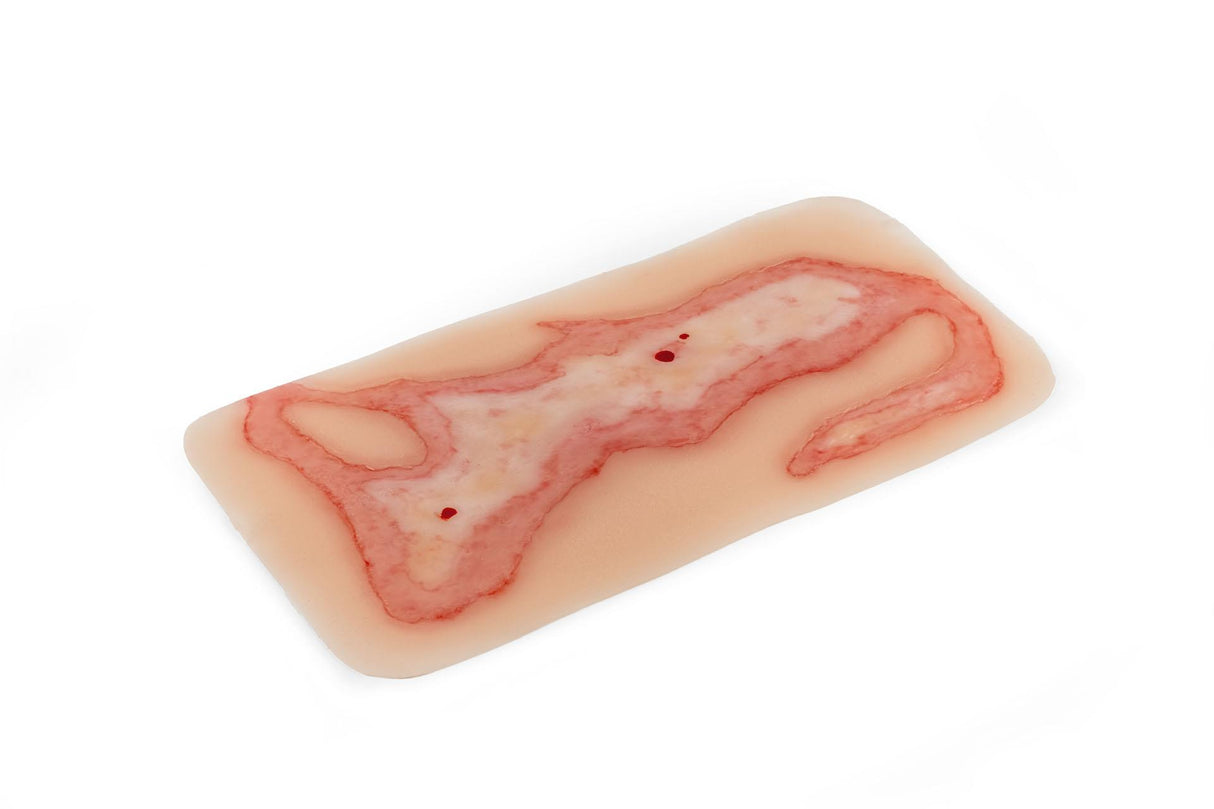 Erler-Zimmer Wundmoulage Verbrühung