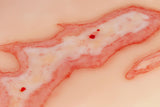 Erler-Zimmer Wundmoulage Verbrühung