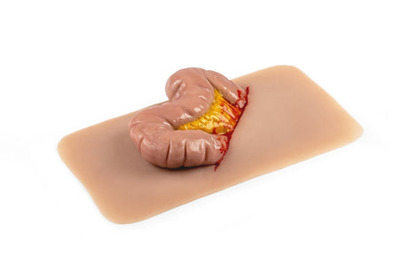 Erler-Zimmer Wundmoulage Dickdarmaustritt
