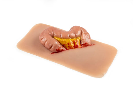Erler-Zimmer Wundmoulage Dickdarmaustritt