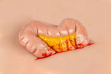 Erler-Zimmer Wundmoulage Dickdarmaustritt