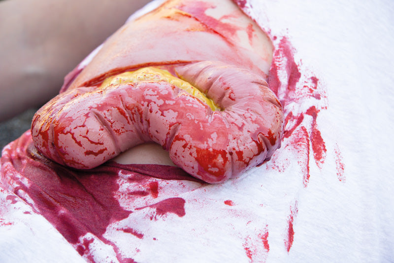 Erler-Zimmer Wundmoulage Dickdarmaustritt
