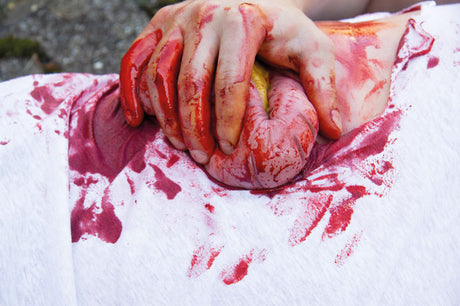 Erler-Zimmer Wundmoulage Dickdarmaustritt