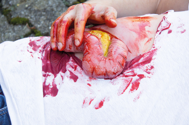 Erler-Zimmer Wundmoulage Dickdarmaustritt