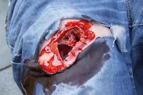 Erler-Zimmer Wundmoulage wound packing