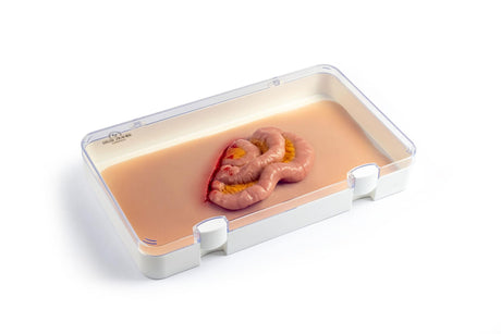 Erler-Zimmer Wundmoulage Dünndarmaustritt