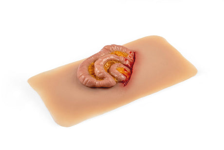 Erler-Zimmer Wundmoulage Dünndarmaustritt