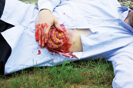 Erler-Zimmer Wundmoulage Dünndarmaustritt