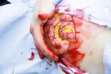 Erler-Zimmer Wundmoulage Dünndarmaustritt