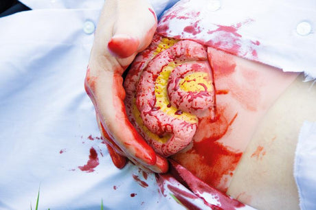 Erler-Zimmer Wundmoulage Dünndarmaustritt