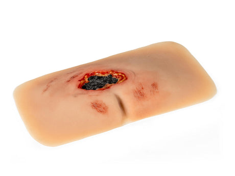 Erler-Zimmer Wundmoulage sakraler Dekubitus, gesäubert