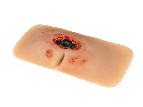 Erler-Zimmer Wundmoulage sakraler Dekubitus, gesäubert