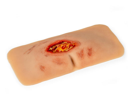 Erler-Zimmer Wundmoulage sakraler Dekubitus, gesäubert