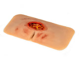 Erler-Zimmer Wundmoulage sakraler Dekubitus, gesäubert
