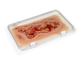 Erler-Zimmer Wundmoulage Ulcus Cruris Venosum, groß, Epithelisierungsphase