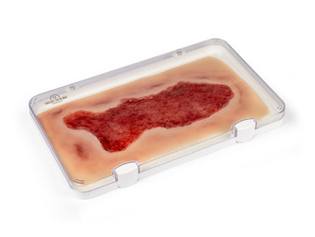 Erler-Zimmer Wundmoulage Ulcus Cruris Venosum, groß, Epithelisierungsphase