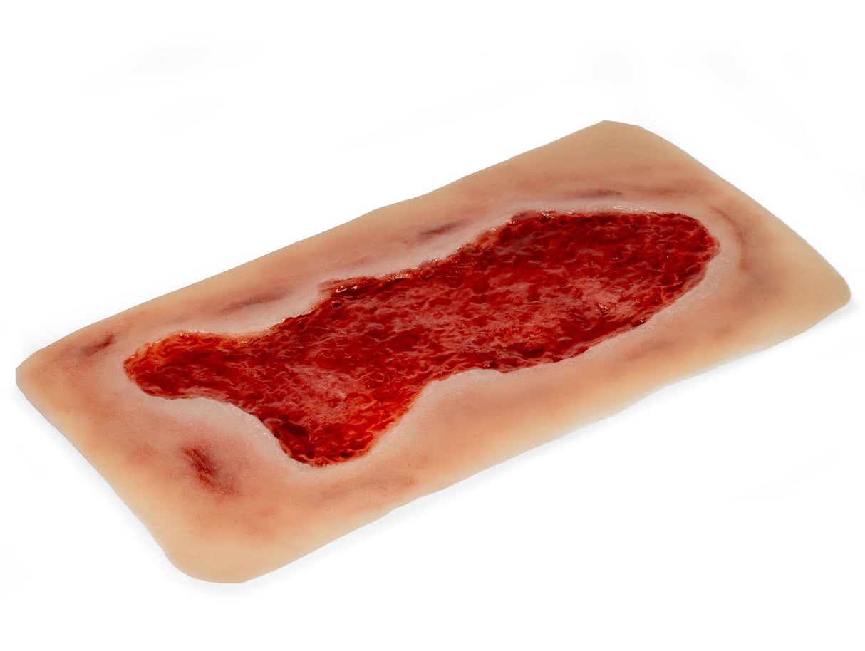 Erler-Zimmer Wundmoulage Ulcus Cruris Venosum, groß, Epithelisierungsphase