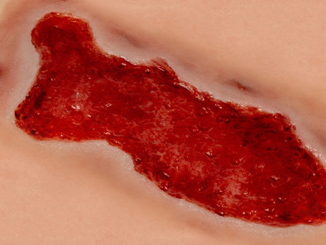 Erler-Zimmer Wundmoulage Ulcus Cruris Venosum, groß, Epithelisierungsphase