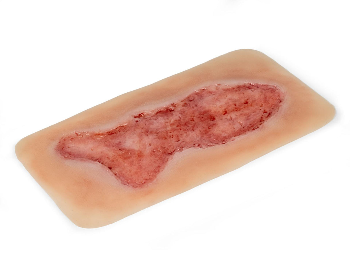 Erler-Zimmer Wundmoulage Ulcus Cruris Venosum, groß, Epithelisierungsphase