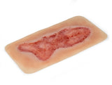 Erler-Zimmer Wundmoulage Ulcus Cruris Venosum, groß, Epithelisierungsphase