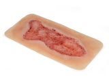 Erler-Zimmer Wundmoulage Ulcus Cruris Venosum, groß, Epithelisierungsphase