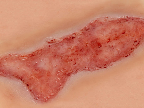 Erler-Zimmer Wundmoulage Ulcus Cruris Venosum, groß, Epithelisierungsphase