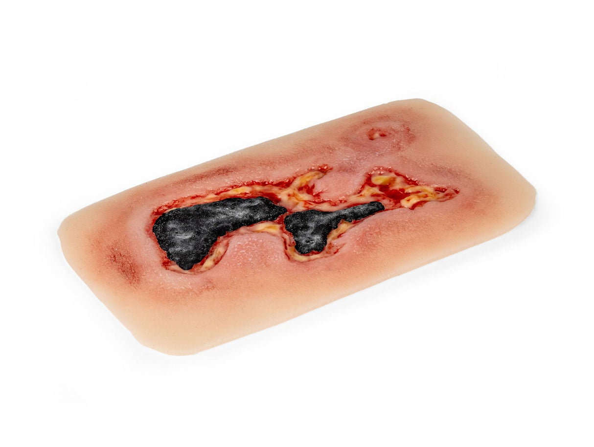 Erler-Zimmer Wundmoulage Ulcus Cruris Arteriosum, groß, Epithelisierungsphase
