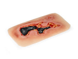 Erler-Zimmer Wundmoulage Ulcus Cruris Arteriosum, groß, Epithelisierungsphase