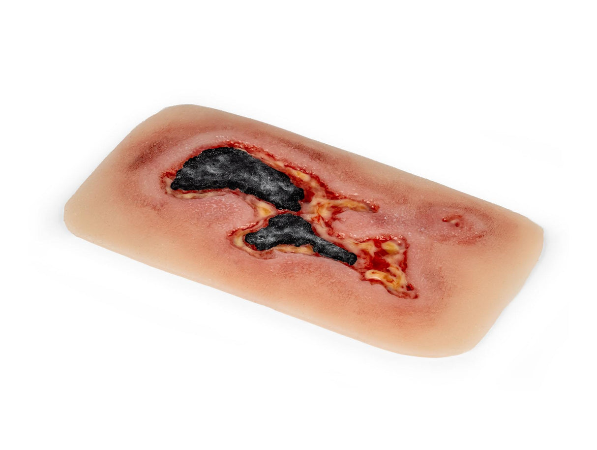 Erler-Zimmer Wundmoulage Ulcus Cruris Arteriosum, groß, Epithelisierungsphase