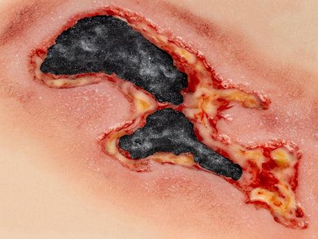 Erler-Zimmer Wundmoulage Ulcus Cruris Arteriosum, groß, Epithelisierungsphase
